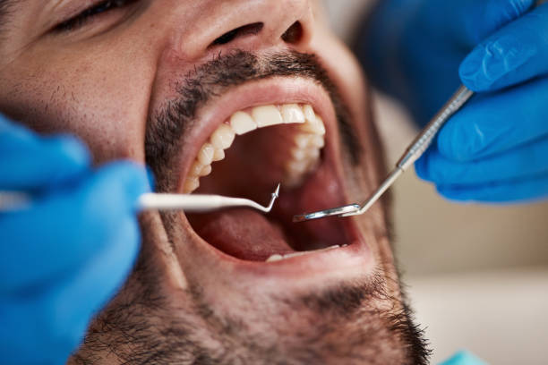 Best Emergency Root Canal Treatment in Rose Hill, KS