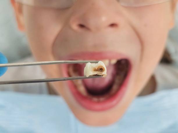 Best Emergency Tooth Extraction in Rose Hill, KS